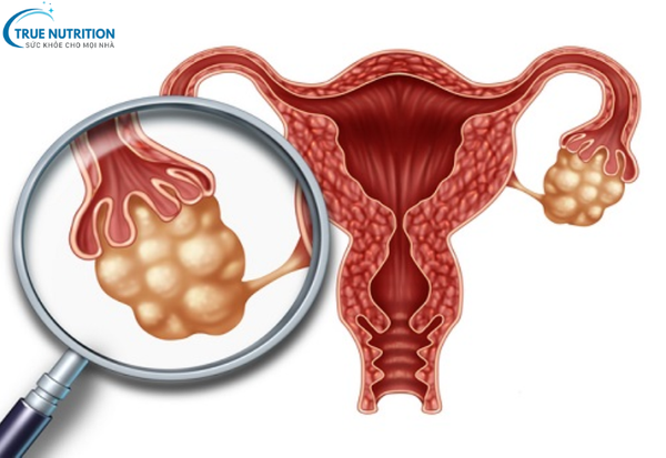 Bệnh U Nang Buồng Trứng: Cách Phát Hiện Sớm Và Giảm Nguy Cơ Biến Chứng