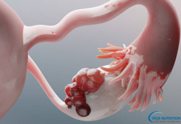 Bệnh U Nang Buồng Trứng: Cách Phát Hiện Sớm Và Giảm Nguy Cơ Biến Chứng