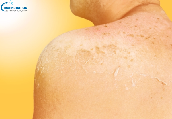 Có Nên Peel Da Không? Tất Cả Những Điều Bạn Cần Biết Trước Khi Làm