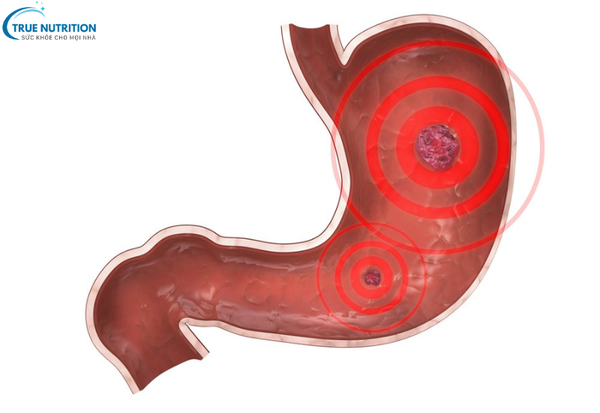 Ung Thư Dạ Dày: Cách Phòng Ngừa Hiệu Quả Mà Bạn Cần Biết