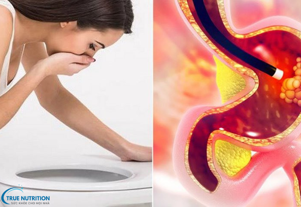 Ung Thư Dạ Dày: Cách Phòng Ngừa Hiệu Quả Mà Bạn Cần Biết