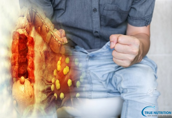 Ung Thư Đại Trực Tràng:&nbsp; Phát Hiện Sớm Và Điều Trị Kịp Thời