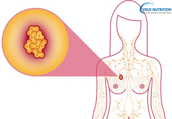 Ung thư vú: Những dấu hiệu cảnh báo sớm và cách phòng ngừa hiệu quả