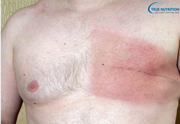 Ung thư vú: Những dấu hiệu cảnh báo sớm và cách phòng ngừa hiệu quả