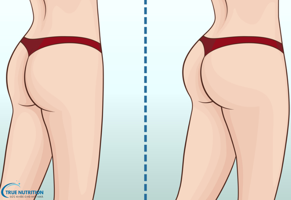 Nâng Mông Giá Bao Nhiêu? Những Yếu Tố Quyết Định Chi Nâng Mông