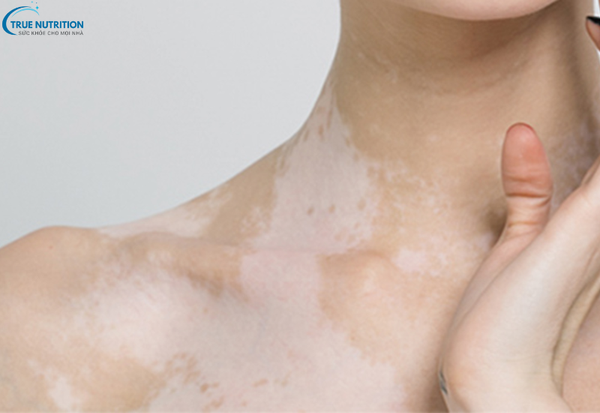 Cách Chữa Bệnh Bạch Biến: Những Phương Pháp Điều Trị Không Thể Bỏ Qua!