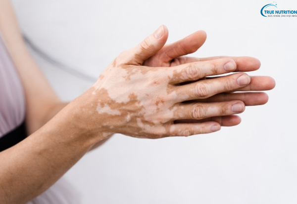 Cách Chữa Bệnh Bạch Biến: Những Phương Pháp Điều Trị Không Thể Bỏ Qua!