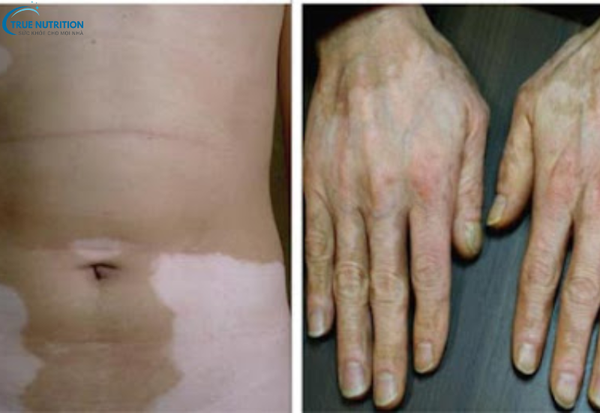 Cách Chữa Bệnh Bạch Biến: Những Phương Pháp Điều Trị Không Thể Bỏ Qua!