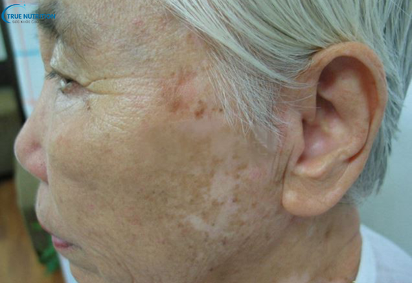 Cách Chữa Bệnh Bạch Biến: Những Phương Pháp Điều Trị Không Thể Bỏ Qua!