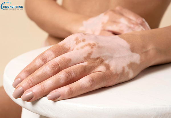 Cách Chữa Bệnh Bạch Biến: Những Phương Pháp Điều Trị Không Thể Bỏ Qua!