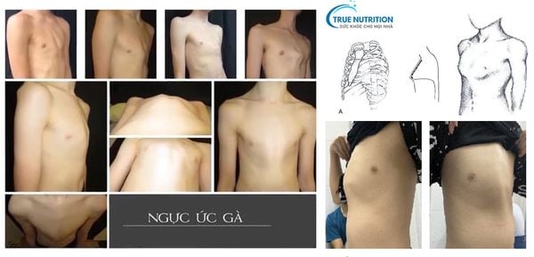 Hình Ảnh Trẻ Bị Nhô Xương Ức Gà: Nguyên Nhân & Phương Pháp Điều Trị