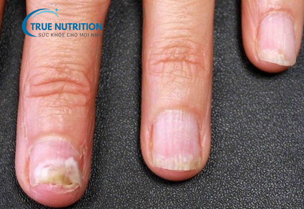 Nấm Móng - Nguyên Nhân, Triệu Chứng và Cách Điều Trị Hiệu Quả