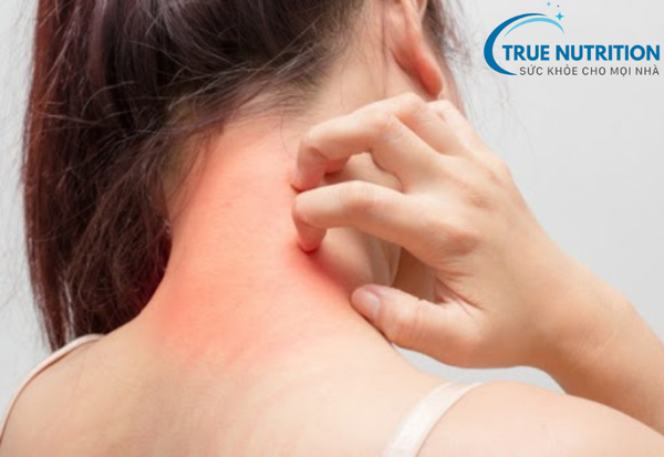 Viêm da dị ứng: Dấu hiệu, nguyên nhân và cách điều trị hiệu quả
