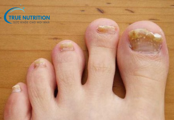 Nấm Móng - Nguyên Nhân, Triệu Chứng và Cách Điều Trị Hiệu Quả