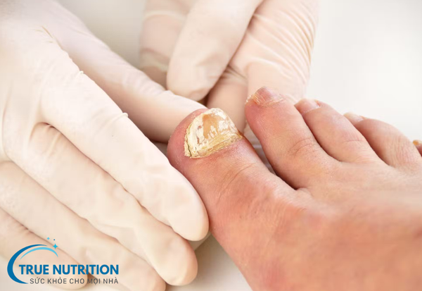 Nấm Móng - Nguyên Nhân, Triệu Chứng và Cách Điều Trị Hiệu Quả