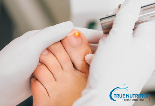 Nấm Móng - Nguyên Nhân, Triệu Chứng và Cách Điều Trị Hiệu Quả