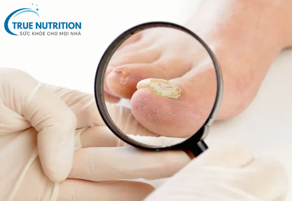 Nấm Móng - Nguyên Nhân, Triệu Chứng và Cách Điều Trị Hiệu Quả