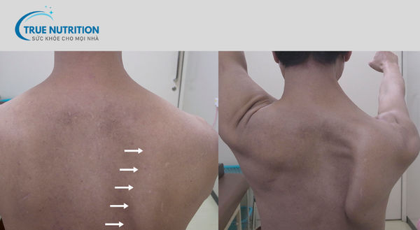 vấn đề về thần kinh trong đột quỵ