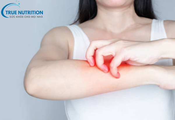 Vì Sao Bị Viêm Da Cơ Địa? Xử Lý Đúng Cách Và Điều Trị Hiệu Quả
