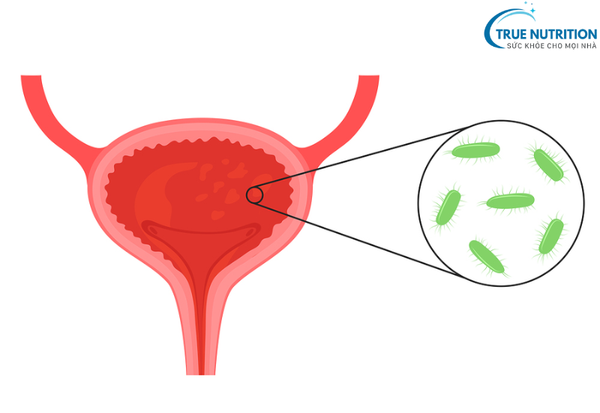 Viêm Bàng Quang -&nbsp; Những Biến Chứng Nguy Hiểm và Cách Phòng Ngừa