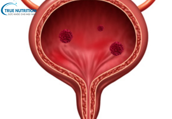 Viêm Bàng Quang -&nbsp; Những Biến Chứng Nguy Hiểm và Cách Phòng Ngừa