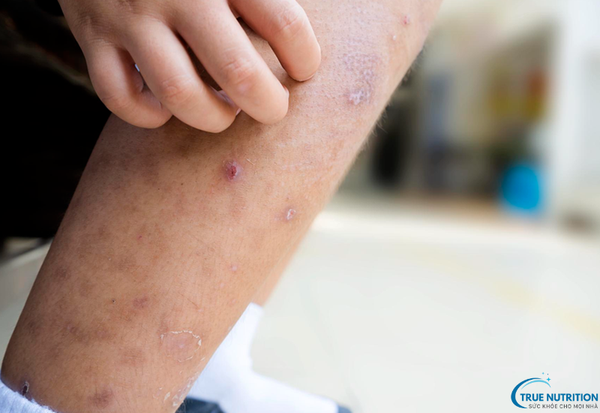 Bệnh viêm da tiếp xúc là gì? Dấu hiệu nhận biết và phương pháp điều trị