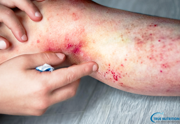 Bệnh viêm da tiếp xúc là gì? Dấu hiệu nhận biết và phương pháp điều trị