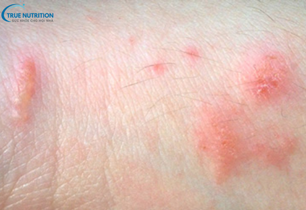 Bệnh viêm da tiếp xúc là gì? Dấu hiệu nhận biết và phương pháp điều trị