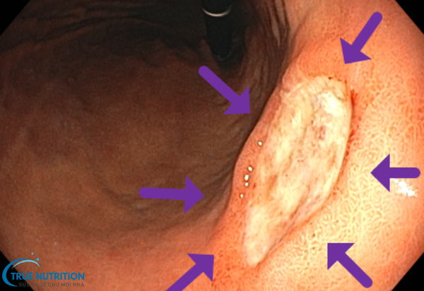 Viêm Loét Dạ Dày Tá Tràng – Mối Nguy Hiểm Tiềm Tàng