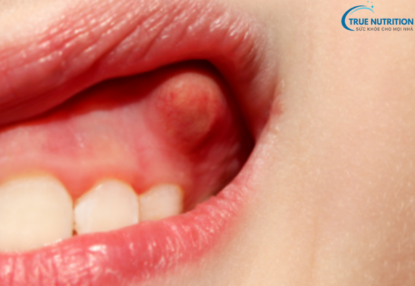 Bệnh Viêm Nha Chu: Những Điều Cần Biết Để Bảo Vệ Sức Khỏe Răng Miệng