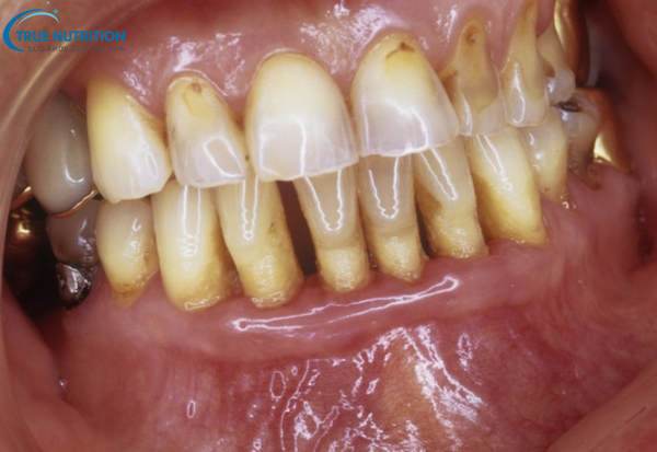Bệnh Viêm Nha Chu: Những Điều Cần Biết Để Bảo Vệ Sức Khỏe Răng Miệng