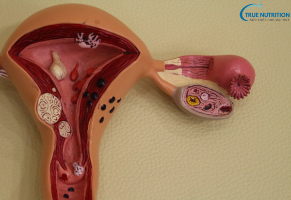 Bệnh Viêm Nhiễm Phụ Khoa: Đừng Để Bệnh Lâu Dài Gây Hại Cho Cơ Thể