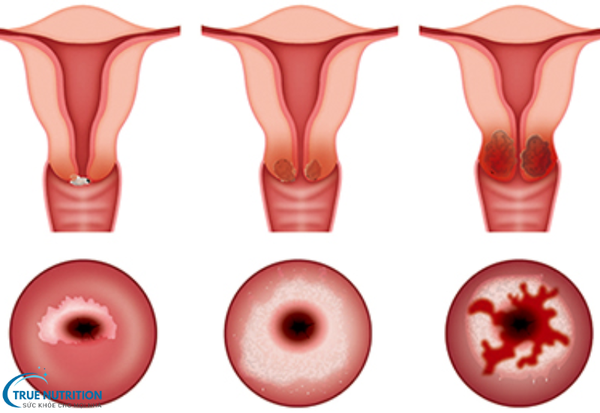 Bệnh Viêm Nhiễm Phụ Khoa: Đừng Để Bệnh Lâu Dài Gây Hại Cho Cơ Thể