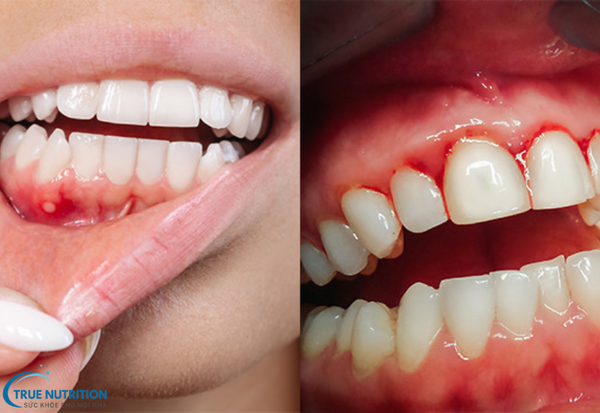 Bệnh Viêm Nướu Răng: Những Điều Cần Biết và Cách Phòng Ngừa Bệnh