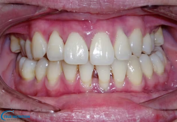 Bệnh Viêm Nướu Răng: Những Điều Cần Biết và Cách Phòng Ngừa Bệnh