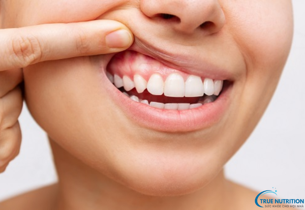 Bệnh Viêm Nướu Răng: Những Điều Cần Biết và Cách Phòng Ngừa Bệnh