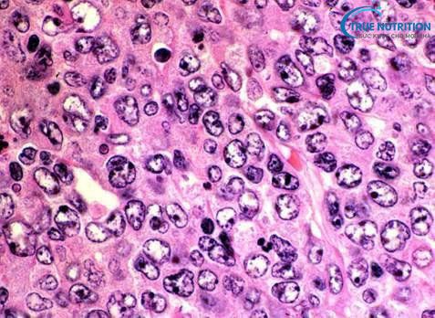 U Lympho Không Hodgkin sống được bao lâu?