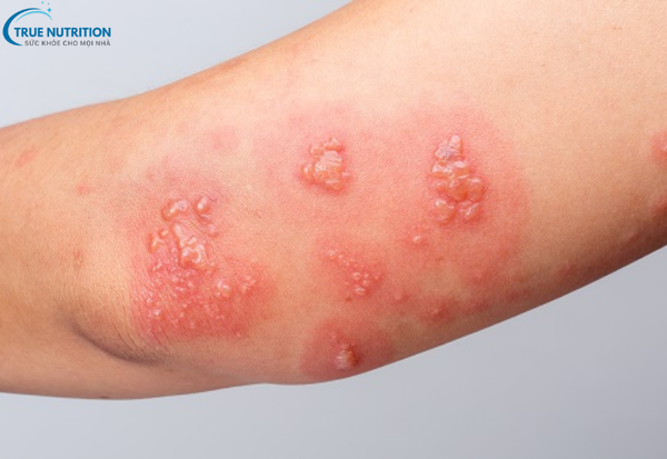 Bệnh Zona Thần Kinh Giời Leo: Dấu Hiệu Nhận Biết Và Biến Chứng Nguy Hiểm