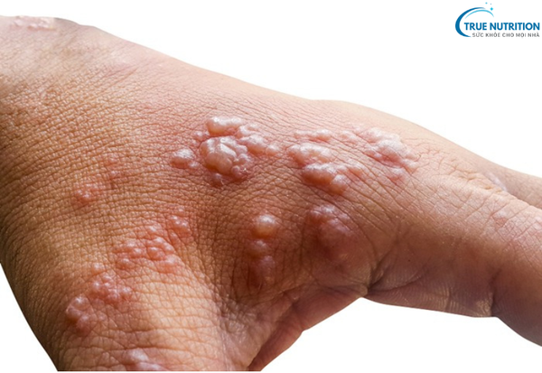 Bệnh Zona Thần Kinh Giời Leo: Dấu Hiệu Nhận Biết Và Biến Chứng Nguy Hiểm