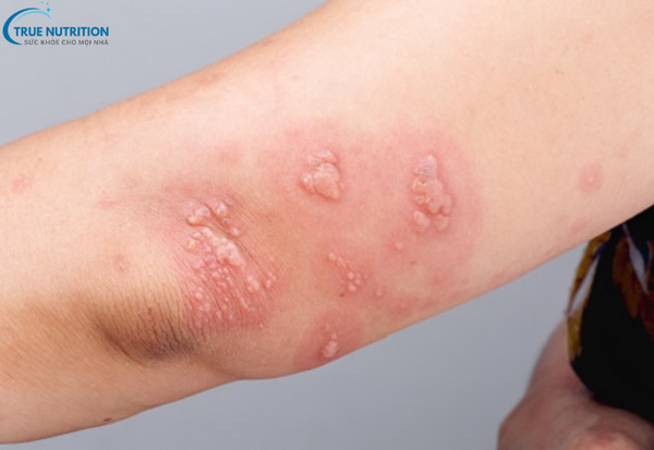 Bệnh Zona Thần Kinh Giời Leo: Dấu Hiệu Nhận Biết Và Biến Chứng Nguy Hiểm