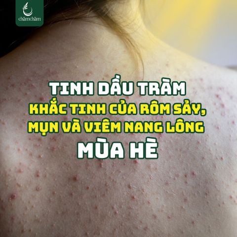 TINH DẦU TRÀM – KHẮC TINH CỦA RÔM SẢY, MỤN VÀ VIÊM NANG LÔNG MÙA HÈ