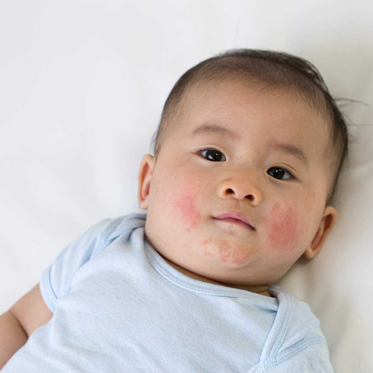 5 bệnh ngoài da thường gặp ở trẻ sơ sinh và trẻ nhỏ
