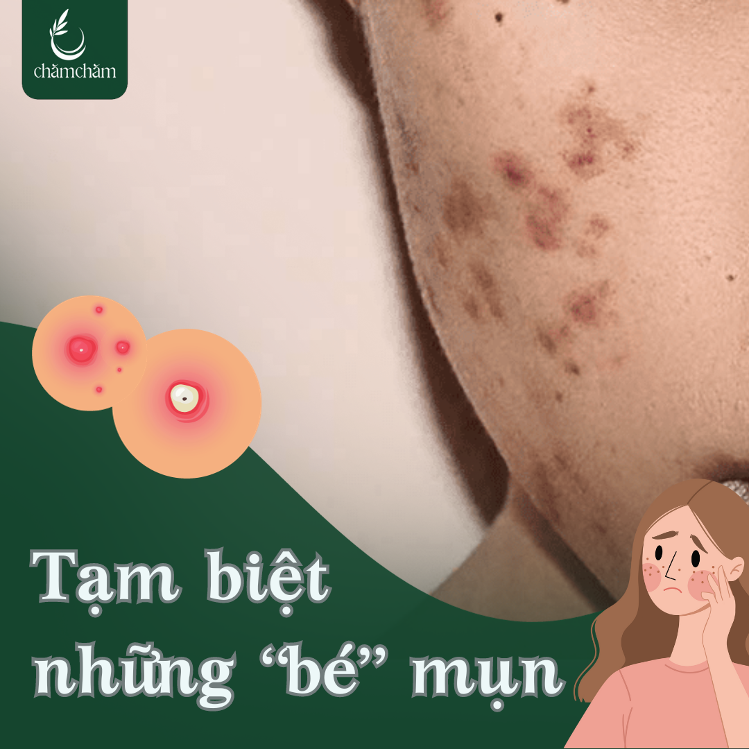 10 CÁCH TRỊ MỤN TỪ THIÊN NHIÊN DỄ LÀM, HIỆU QUẢ