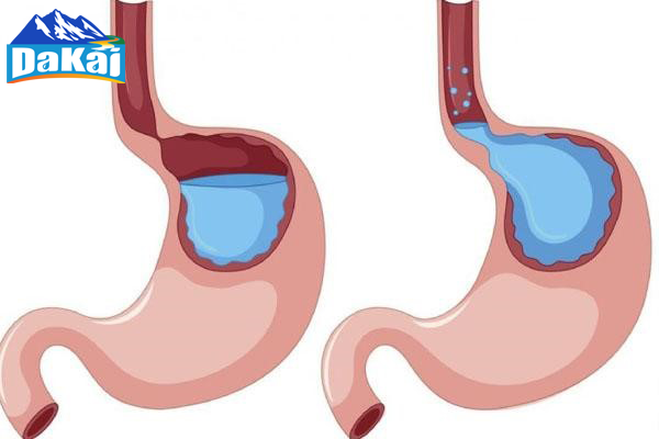 Trào Ngược Dạ Dày Uống Nước Gì? Giải Pháp Hiệu Quả Cho Sức Khỏe