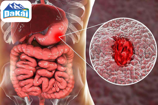 Xuất huyết dạ dày là gì? Bị xuất huyết dạ dày có nguy hiểm đến sức khỏe không?