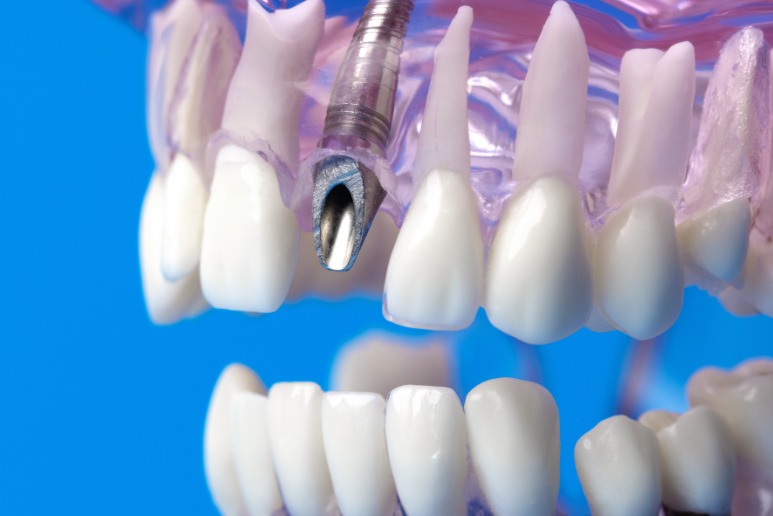 Địa Chỉ Mua Implant Chính Hãng Giá Tốt Ở Nhà Bè