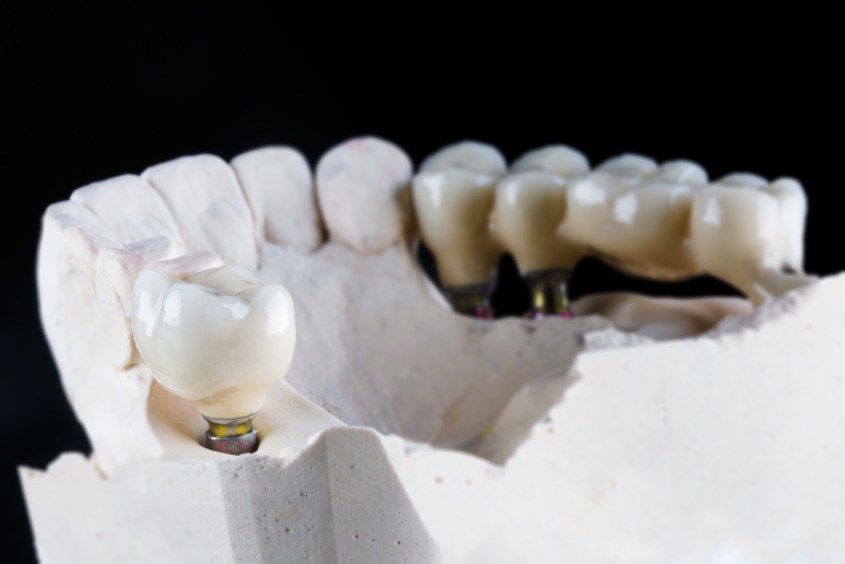 Địa Chỉ Mua Implant Chính Hãng Giá Tốt Tại Phú Yên