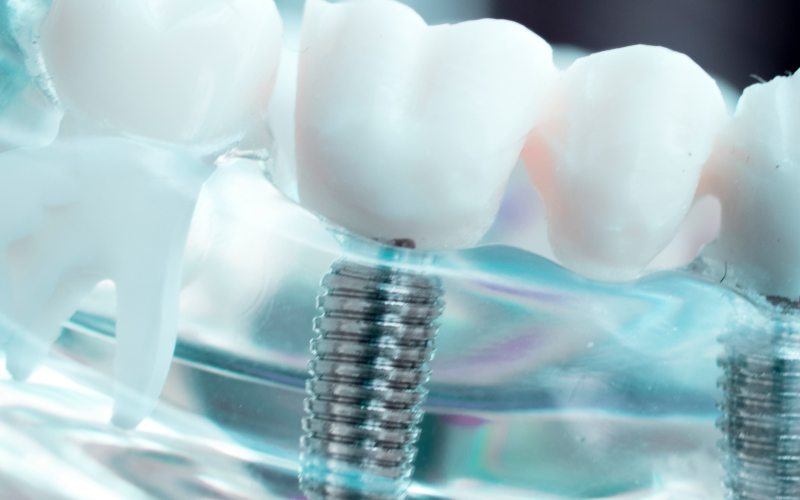 Địa Chỉ Mua Implant Uy Tín Tại Quận 5 Ở Đâu?