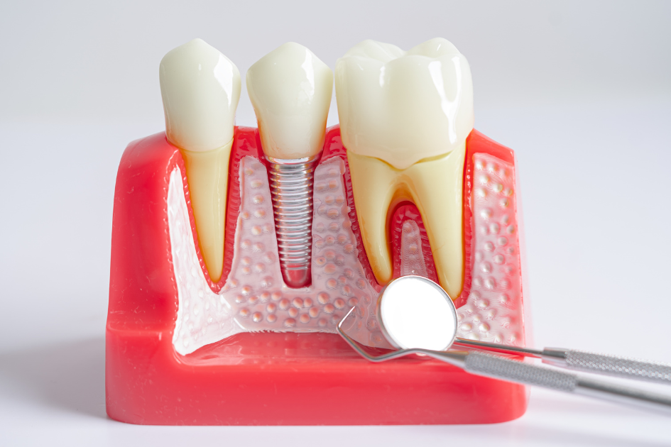 Địa Điểm Mua Implant Giá Hợp Lý Tại Quận 11 Ở Đâu?