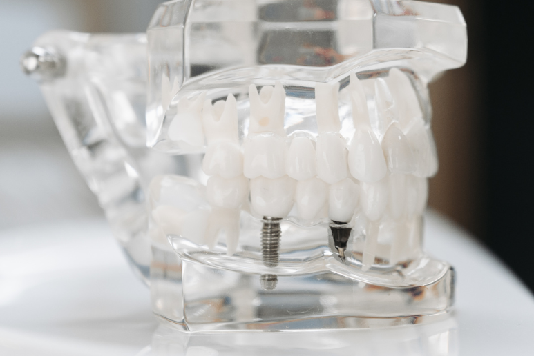 Nơi Mua Implant Chất Lượng Tại Cần Giờ Ở Đâu?